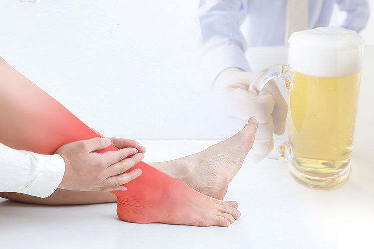 高尿酸血症（痛風）のイメージ画像